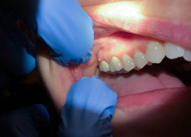 Best Emergency Root Canal Treatment in Hope, IN