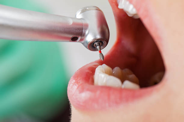 Best Urgent Care for Lost Fillings or Crowns in Hope, IN